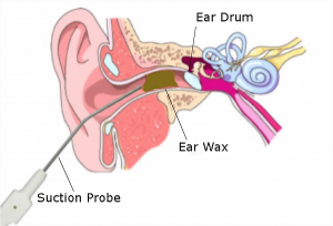 micro-suction earwax
